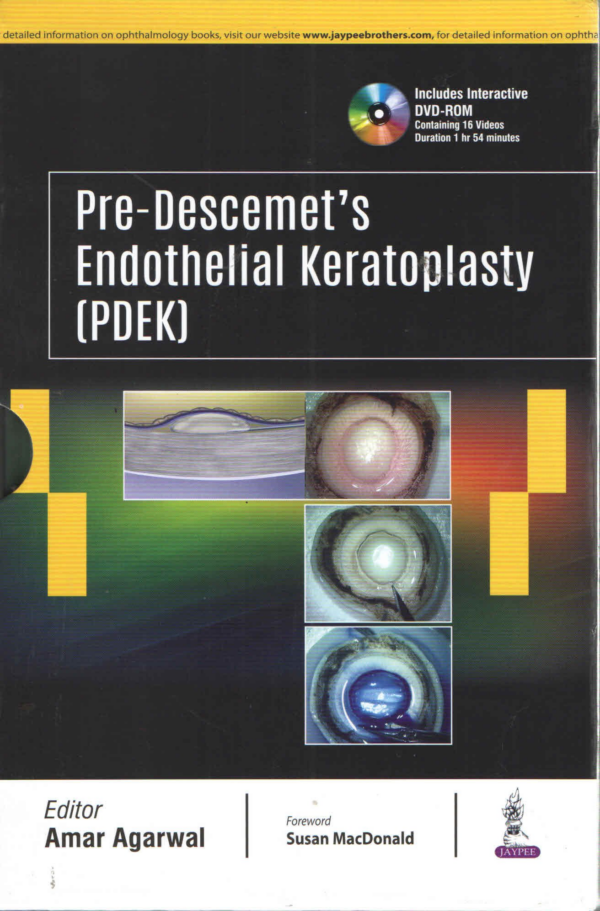 Pre-Descemet's Endothelial Keratoplasty (Pdek)