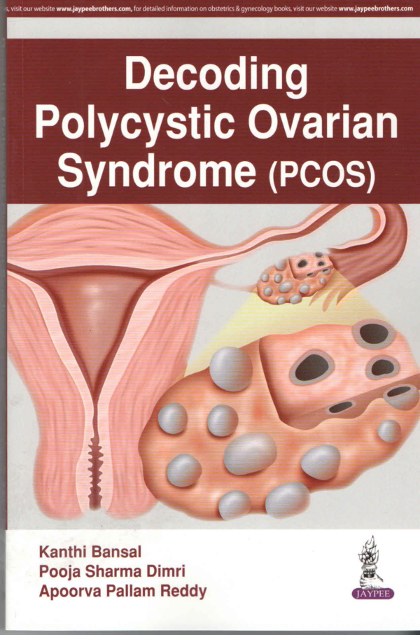 Decoding Polycystic Ovarian Syndrome