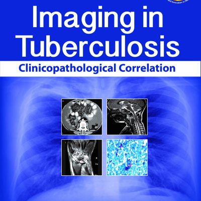 Imaging in Tuberculosis