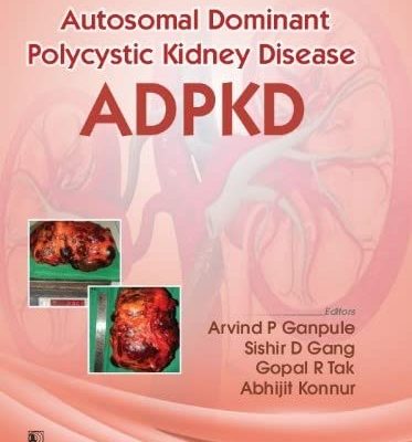 Autosomal Dominant Polycystic Kidney Disease Adpkd (Flexibond 2022)