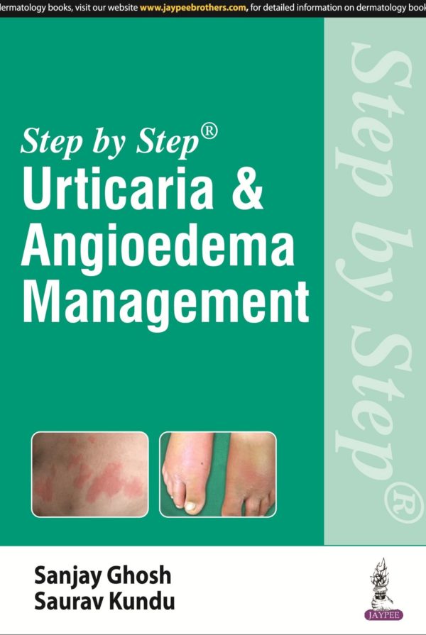 Step By Step Urticaria And Angioedema Management