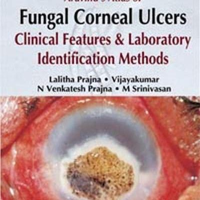 Aravind's Atlas Of Fungal Corneal Ulcers Clinical Features & LabIdentification Methods