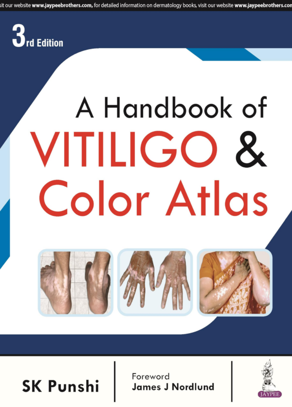 A Handbook Of Vitiligo & Color Atlas