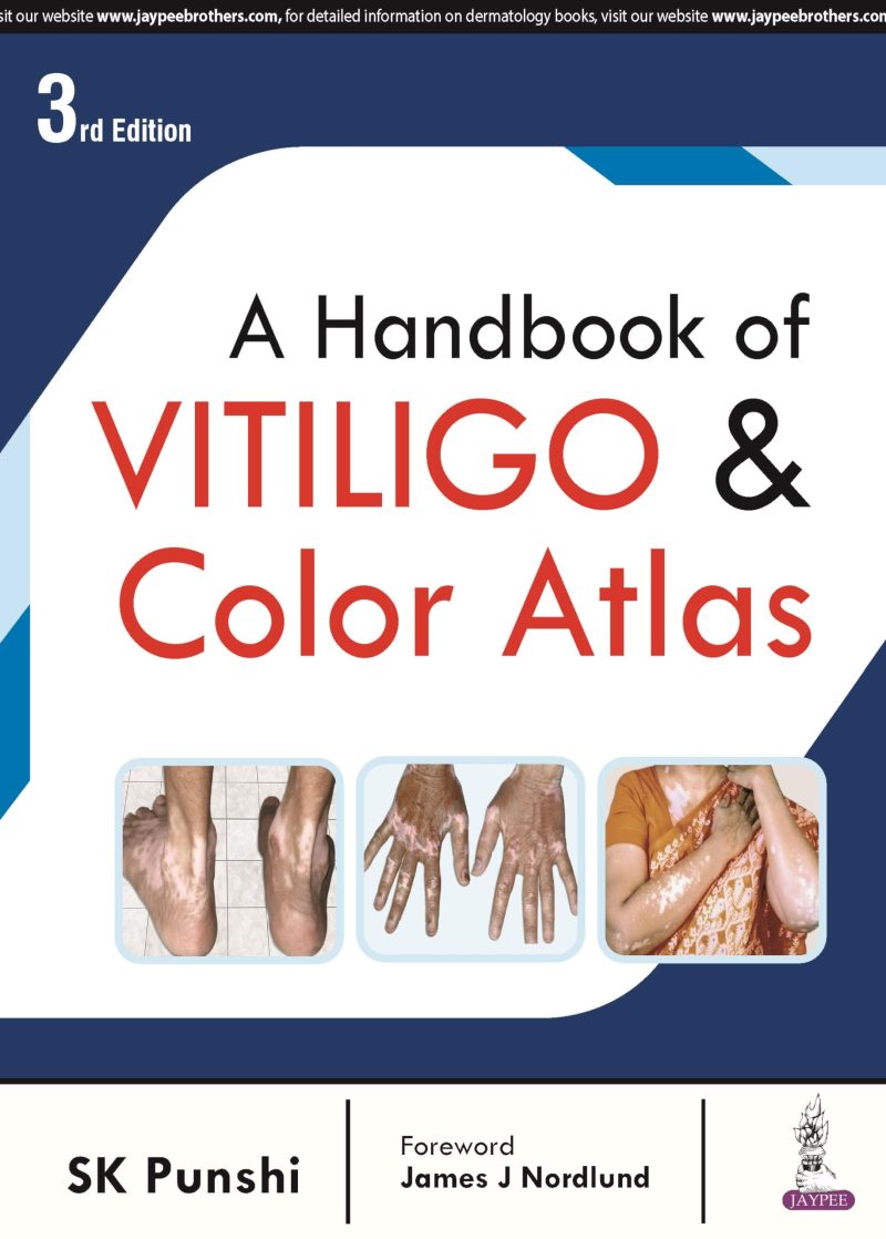 A Handbook Of Vitiligo & Color Atlas