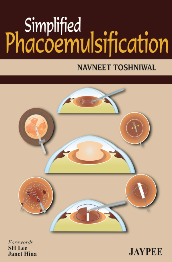 Simplified Phacoemulsification