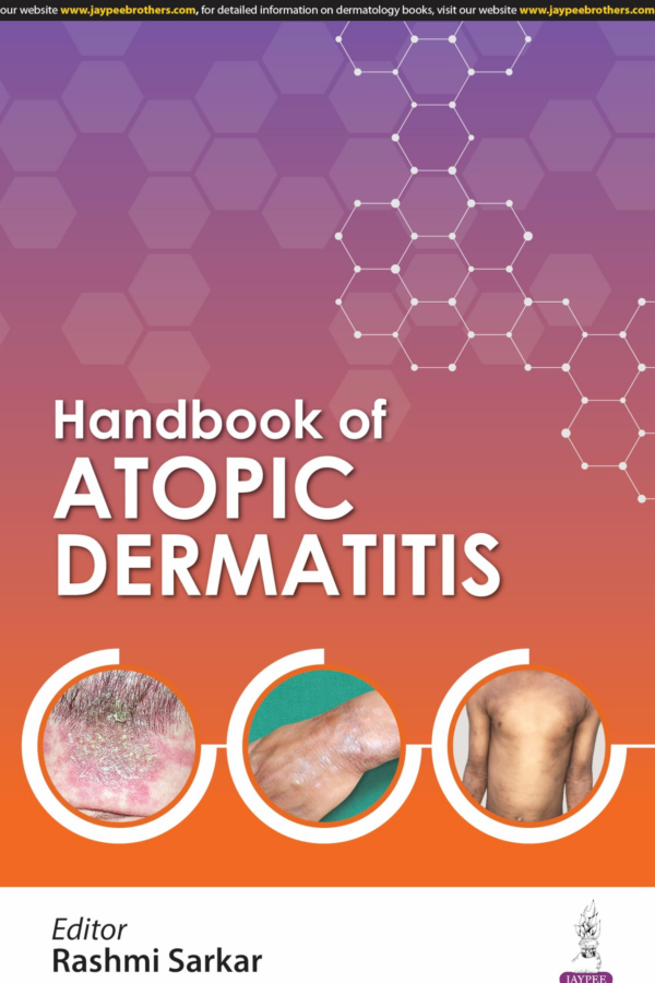 Handbook Of Atopic Dermatitis