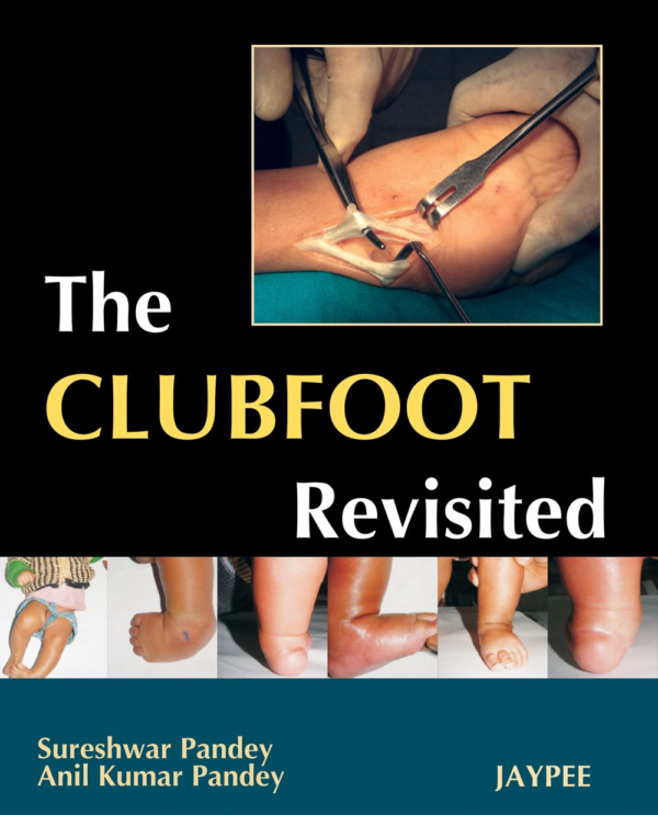The Clubfoot Revisited