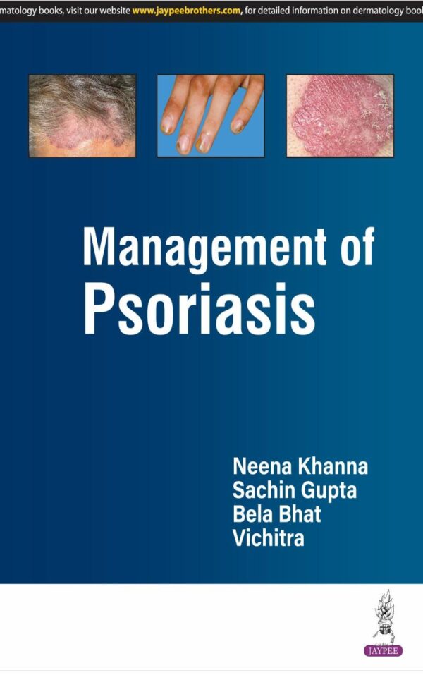 Management of PSORIASIS