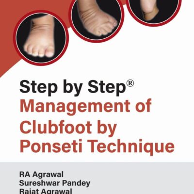 Step By Step Management of Clubfoot By Ponseti Technique