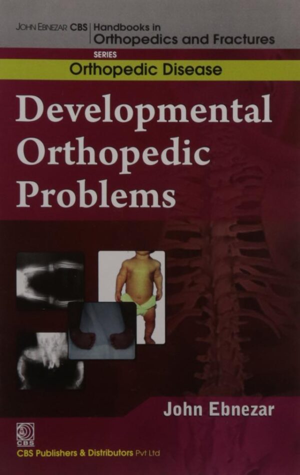 Developmental Orthopedic Problems (Handbooks In Orthopedics and Fractures Series