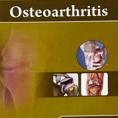 Osteoarthritis (Handbooks In Orthopedics and Fractures Series