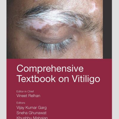 Comprehensive Textbook On Vitiligo (Pb 2022)