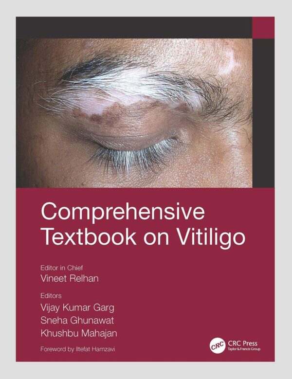 Comprehensive Textbook On Vitiligo (Pb 2022)