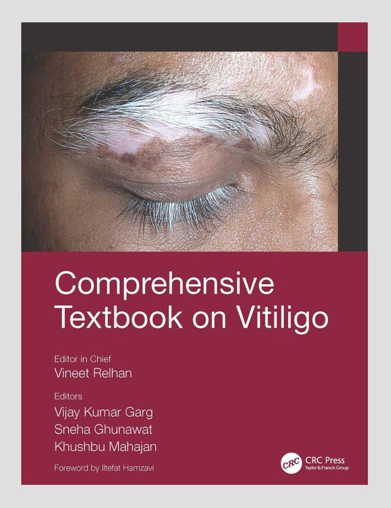 Comprehensive Textbook On Vitiligo (Pb 2022)