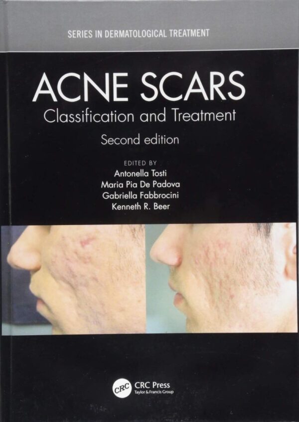 ACNE SCARS CLASSIFICATION AND TREATMENT 2ED (HB 2019)