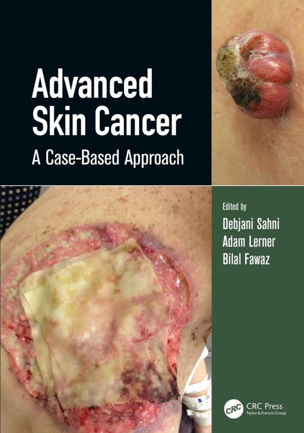 ADVANCED SKIN CANCER A CASE BASED APPROACH (HB 2022)