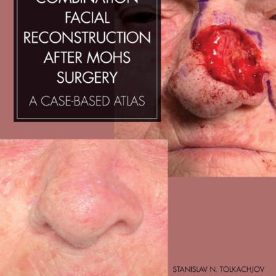 COMBINATION FACIAL RECONSTRUCTION AFTER MOHS SURGERY A CASE BASED ATLAS (HB 2024)