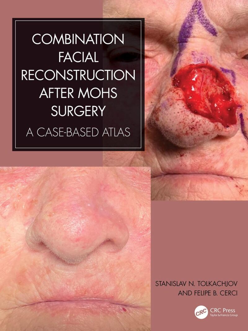 COMBINATION FACIAL RECONSTRUCTION AFTER MOHS SURGERY A CASE BASED ATLAS (HB 2024)