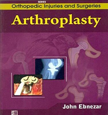 ARTHROPLASTY (HANDBOOKS IN ORTHOPEDICS AND FRACTURES SERIES