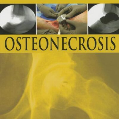 OSTEONECROSIS
