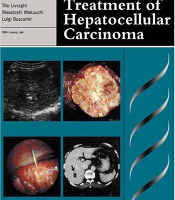Diagnosis and Treatment of Hepatocellular Carcinoma (Greenwich Medical Media)
