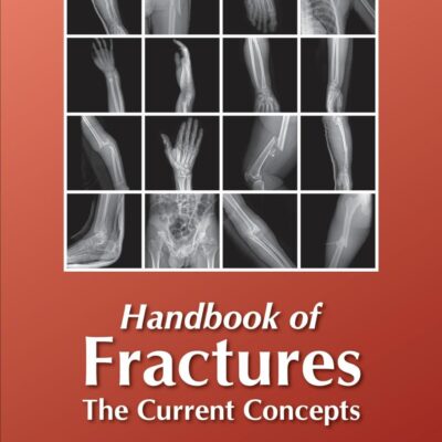 HANDBOOK OF FRACTURES THE CURRENT CONCEPTS