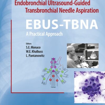 Endobronchial Ultrasound-Guided Transbronchial Needle Aspira