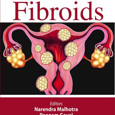 FIBROIDS