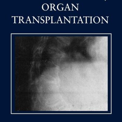 Bone Disease of Organ Transplantation