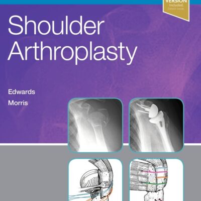 Shoulder Arthroplasty