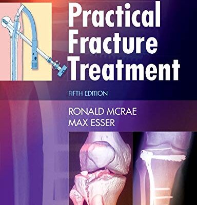 Practical Fracture Treatment, International Edition
