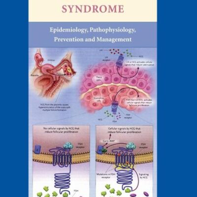 Ovarian Hyperstimulation Syndrome: Epidemiology, Pathophysiology, Prevention and Management