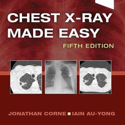 Chest X-Ray Made Easy