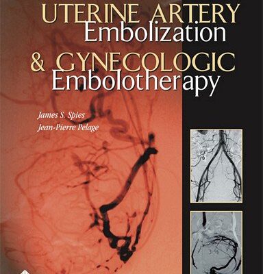Uterine Artery Embolization and Gynecologic Embolotherapy