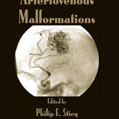 Intracranial Arteriovenous Malformations