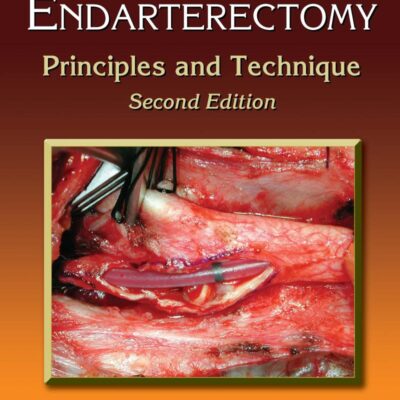 Carotid Endarterectomy: Principles and Technique