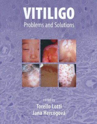 VITILIGO: PROBLEMS AND SOLUTIONS (BASIC AND CLINICAL DERMATOLOGY)