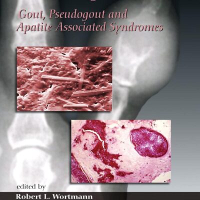 Crystal-Induced Arthropathies: Gout, Pseudogout And Apatite-Associated Syndromes