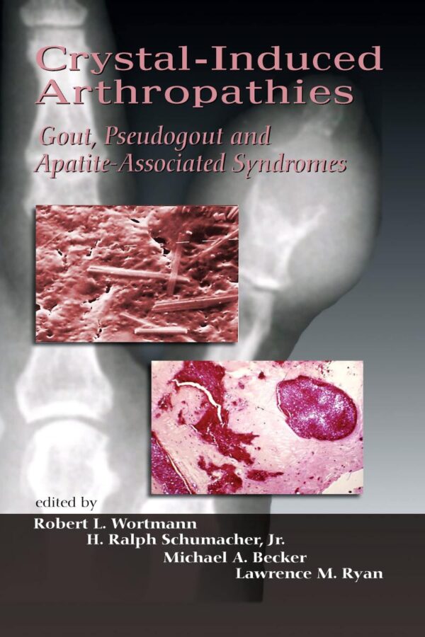 Crystal-Induced Arthropathies: Gout, Pseudogout And Apatite-Associated Syndromes