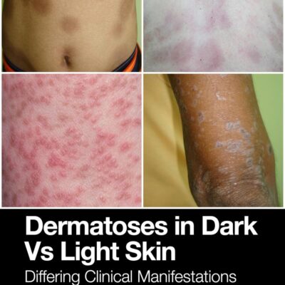 DERMATOSES IN DARK VS LIGHT SKIN DIFFERING CLINICAL MANIFESTATIONS (PB 2025)