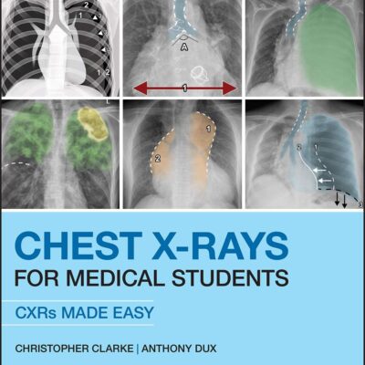 Chest X-Rays For Medical Students: Cxrs Made Easy