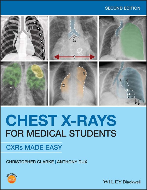 Chest X-Rays For Medical Students: Cxrs Made Easy