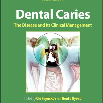 Dental Caries: The Disease and Its Clinical Management