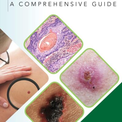 Skin Cancer: A Comprehensive Guide (DERMATOLOGY)
