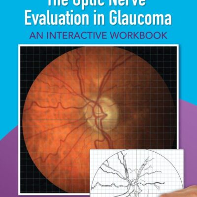 THE OPTIC NERVE EVALUATION IN GLAUCOMA AN INTERACTIVE WORKBOOK (PB 2017)