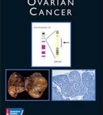 OVARIAN CANCER (AGENCY/DISTRIBUTED)