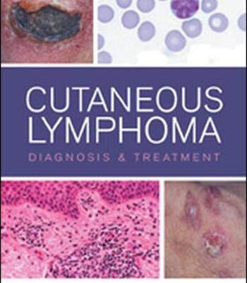 Cutaneous Lymphoma Diagnosis and Treatment