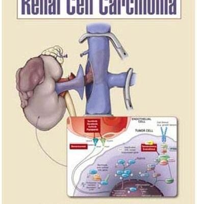 Renal Cell Carcinoma