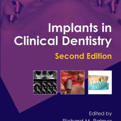 Implants in Clinical Dentistry: 2