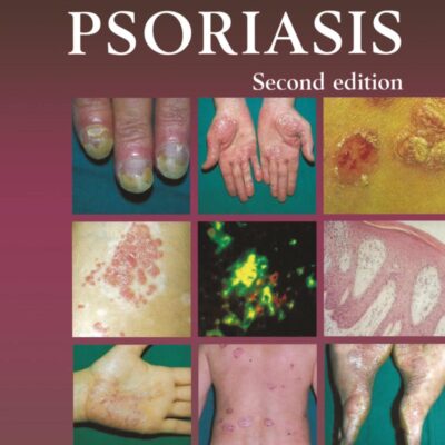 AN ATLAS OF PSORIASIS (ENCYCLOPEDIA OF VISUAL MEDICINE) (ENCYCLOPEDIA OF VISUAL MEDICINE SERIES): 77